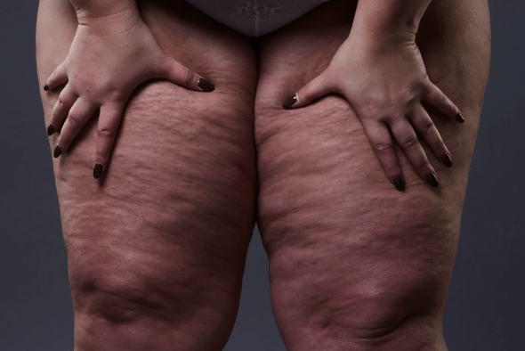 Lipedema - Dra. Alyne Neves Cintra